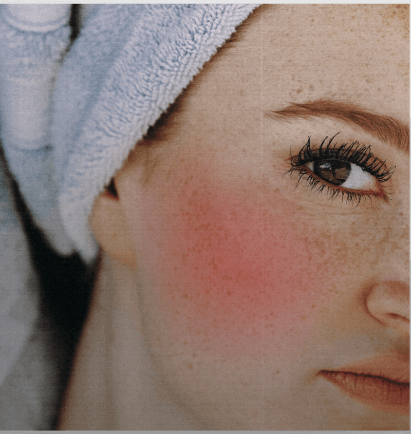 women with rosacea skincare ingredients to avoid finca skin organics
