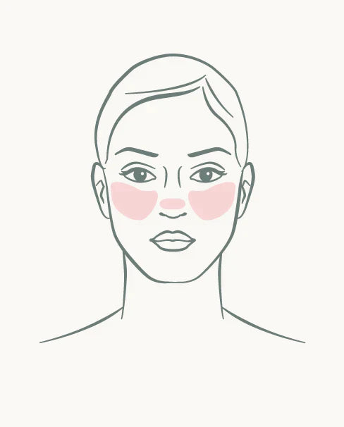 Type 1 — ETR rosacea